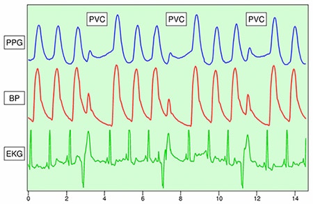 PPG can detect unusual cardiac events such as premature ventricular contraction Image de la PPG capable de détecter des événements cardiaques inhabituels comme des contractions ventriculaires prématurées