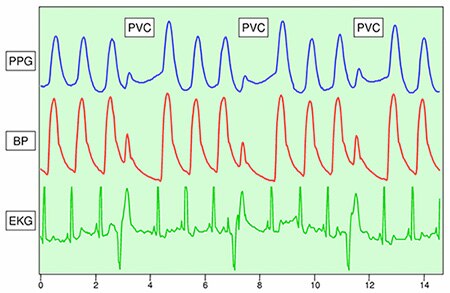 Image of PPG can detect unusual cardiac events such as premature ventricular contraction